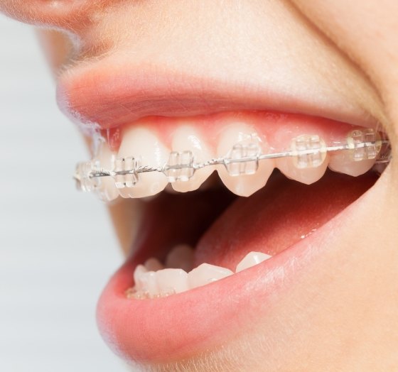 Closeup of smile with clear braces a trusted orthodontic option for adults