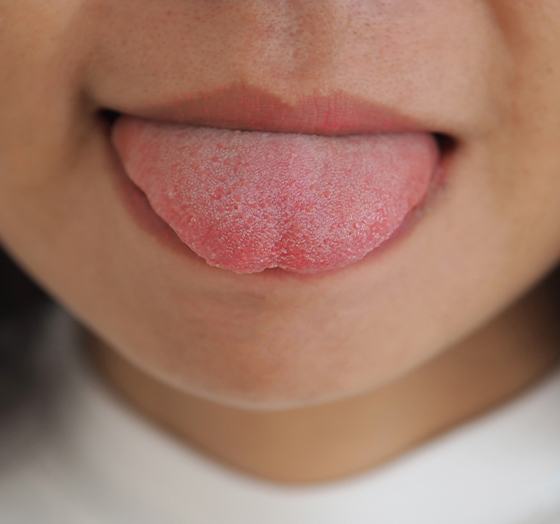 Closeup of child's face before myofunctional therapy