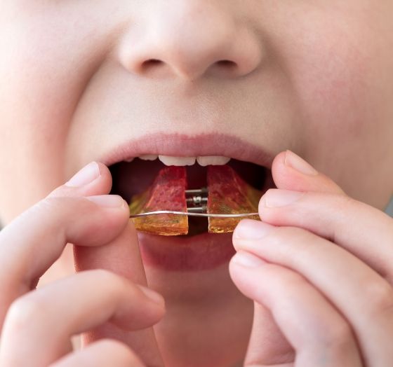 Closeup of child placing an oral appliance