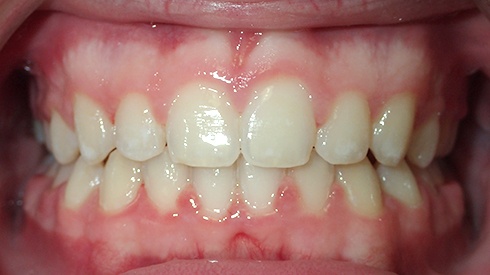 Closeup of patient's smile after treatment for crowding and deep overbite