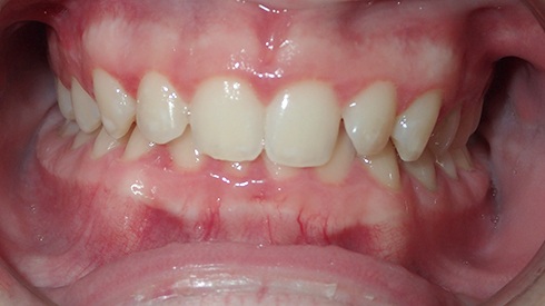 Closeup of patient's smile with crowding and deep overbite