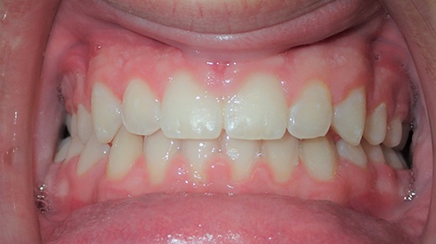 Closeup of smile after treatment for unevenly spaced teeth and deep overbite