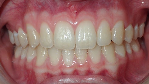 Patient's smile after treatment for crowded teeth and deep overbite