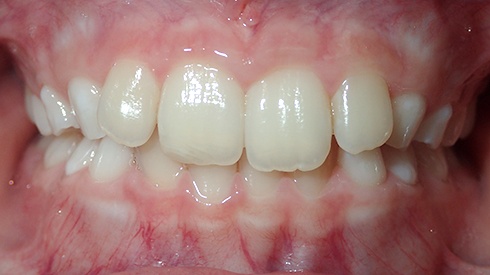 Patient's smile with croweded teeth and deep overbite