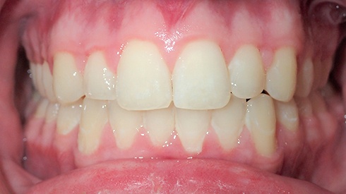 Closeup of smile after treatment for crowding deep overbite and excess overjet