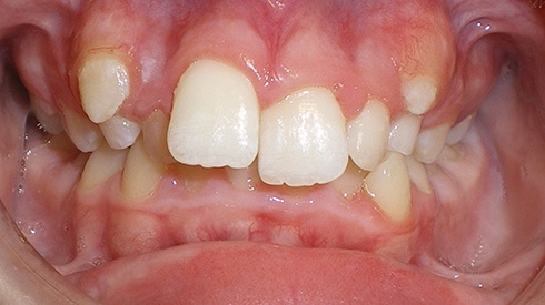Closeup of smile with crowding deep overbite and excess overjet