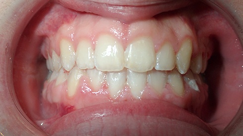 Smile after treatment for spacing issues excess overjet deep overbite and narrow maxilla