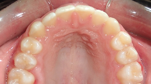 Inisde of lower teeth after treatment for spacing issues excess overjet deep overbite and narrow maxilla