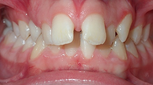 Smile with spacing issues excess overjet deep overbite and narrow maxilla
