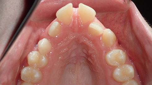 Inside of lower teeth with spacing issues excess overjet deep overbite and narrow maxilla