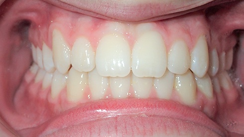 Closeup of smile after treatment for uneven spacing crossbite and narrow upper jaw