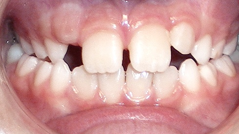 Closeup of smile with uneven spacing crossbite and narrow upper jaw