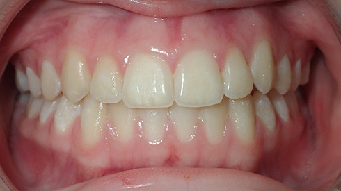 Closeup of smile after treatment for crowded teeth and high canines
