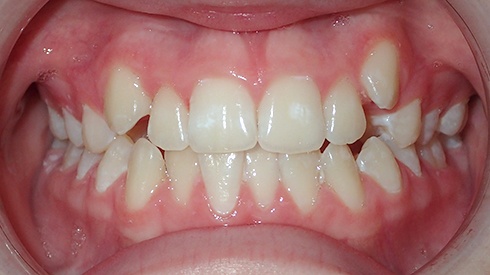 Closeup of smile with crowded teeth and high canines