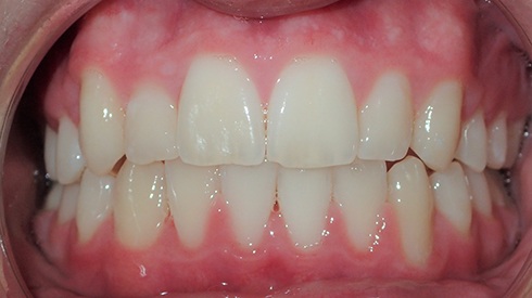 Closeup of patient's smile after treatment for crowding and high canines