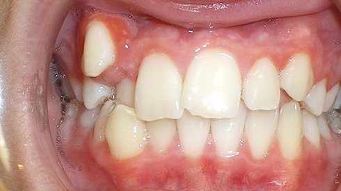 Closeup of patient's smile with crowding and high canines