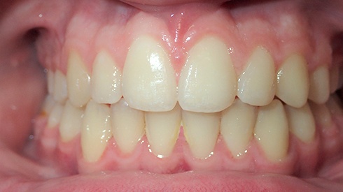 Patient's smiel after treatment for uneven spacing deep overbite and excess overjet