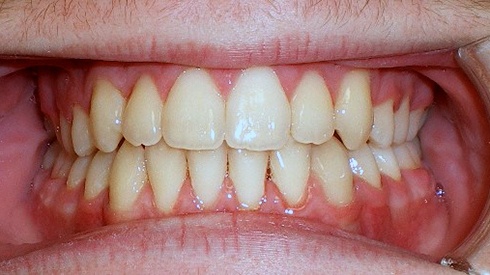 Closeup of smile after spacing open bite and narrow maxilla were addressed with traditional braces