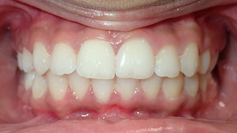 Smile after treatment for deep overbite excess overjet and spacing issues