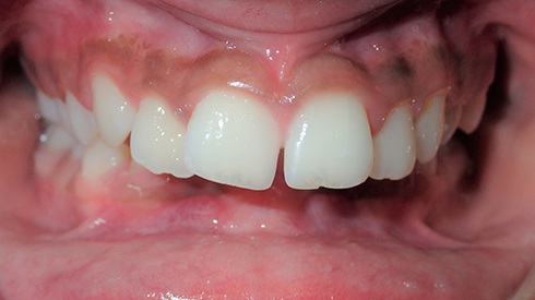 Smile with deep overbite excess overjet and spcaing issues
