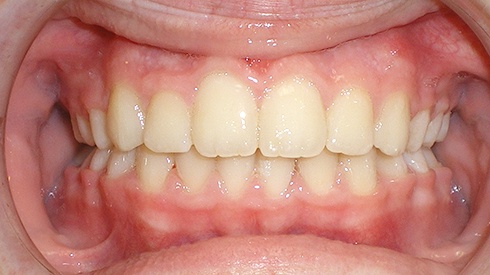 Closeup of smile after treatment for deep overbite anterior crossbite and spacing issues