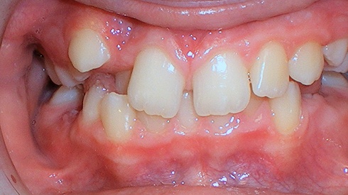 Closeup of smile with deep overbite anterior crossbite and spacing issues