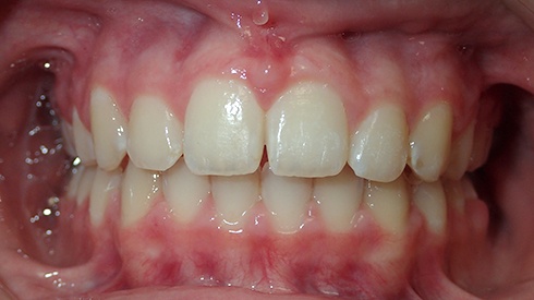 Closeup of smile after treatment for excess overjet and spacing issues