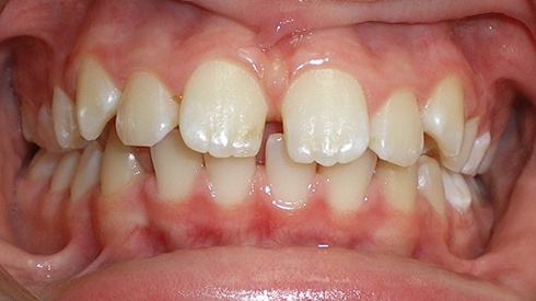 Closeup of smile with excess overjet and spacing issues
