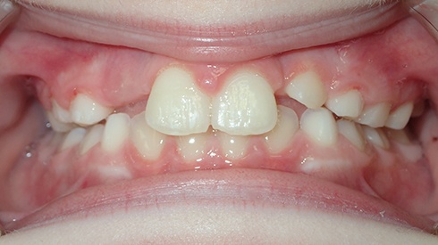Smile after treatment for anterior and posterior crossbite retracted and narrow upper jaw and airway restriction