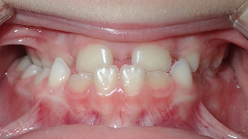 Smile with anterior and posterior crossbite retracted and narrow upper jaw and airway restriction