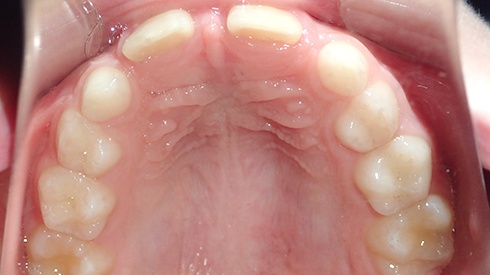 Inside of mouth with anterior and posterior crossbite retracted and narrow upper jaw and airway restriction