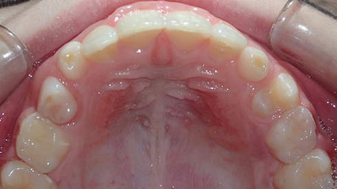 Closeup of smile after treatment for narrow upper jaw and airway restriction