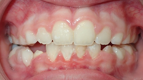 Smile after treatment for narrow upper jaw airway restriction and openbite