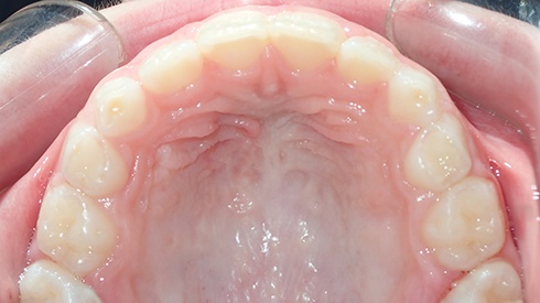 Inside of mouth after treatment for narrow upper jaw airway restriction and openbite