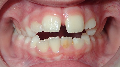 Smile with narrow upper jaw airway restriction and openbite