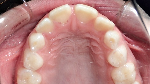 Inside of mouth with narrow upper jaw airway restriction and openbite