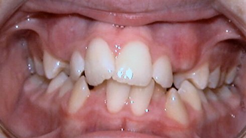 Closeup of smile with crowded teeth