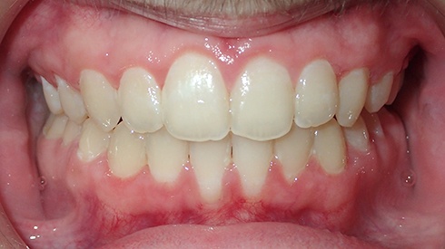 Closeup of smile after crowded teeth narrow upper jaw and deep overbite are corrected