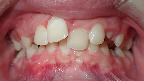 Closeup of smile crowded teeth narrow upper jaw and deep overbite