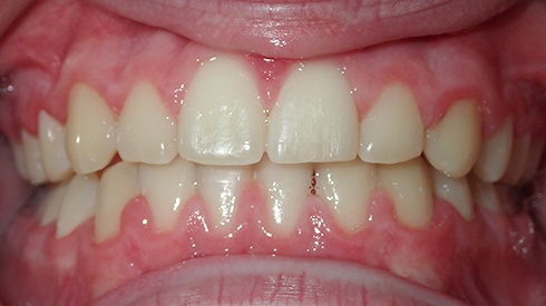 Closeup of smile after tooth crowing and crossbite are treated
