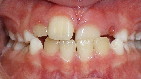 Closeup of smile with tooth crowding and crossbite