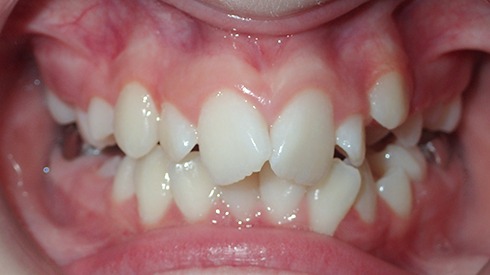 Closeup of smile with crowded teeth
