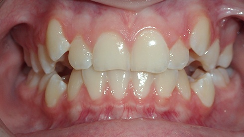 Closeup of smile with tooth crowding