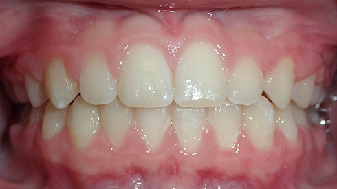 Closeup of smile after treatment for crowding and deep overbite