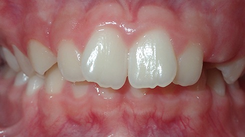 Closeup of smile with crowding and deep overbite
