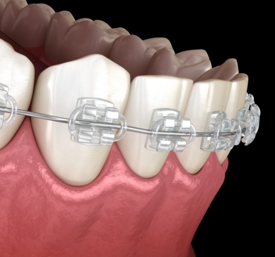 Animated smile with clear and ceramic bracket and wire braces