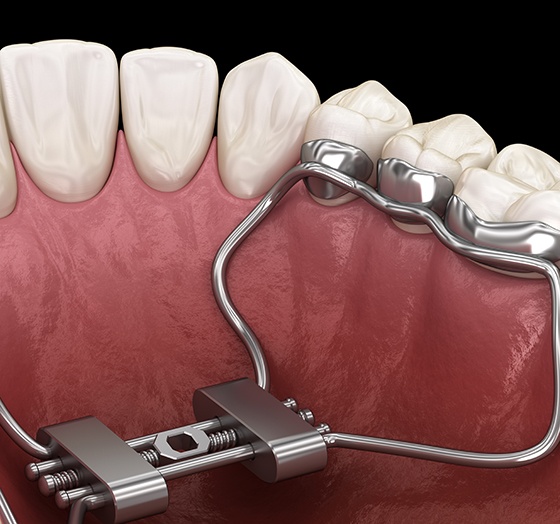 Close-up illustration of a palatal expander