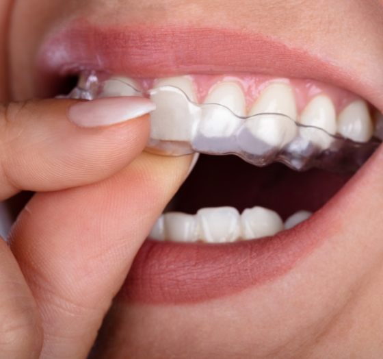 Closeup of patient placing Invisalign tray over smile