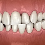 Illustration of an overbite