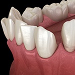 Illustration of an underbite